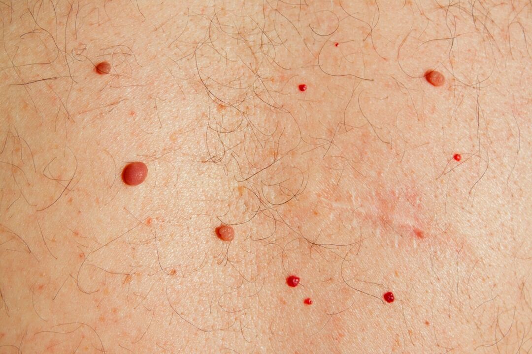 Papilómy na tele spôsobené HPV