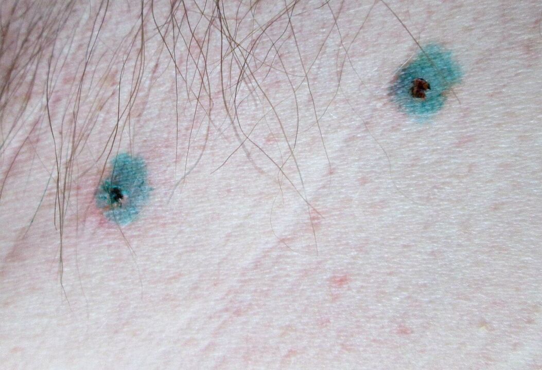 Značky na koži po laserovom odstránení papilómov